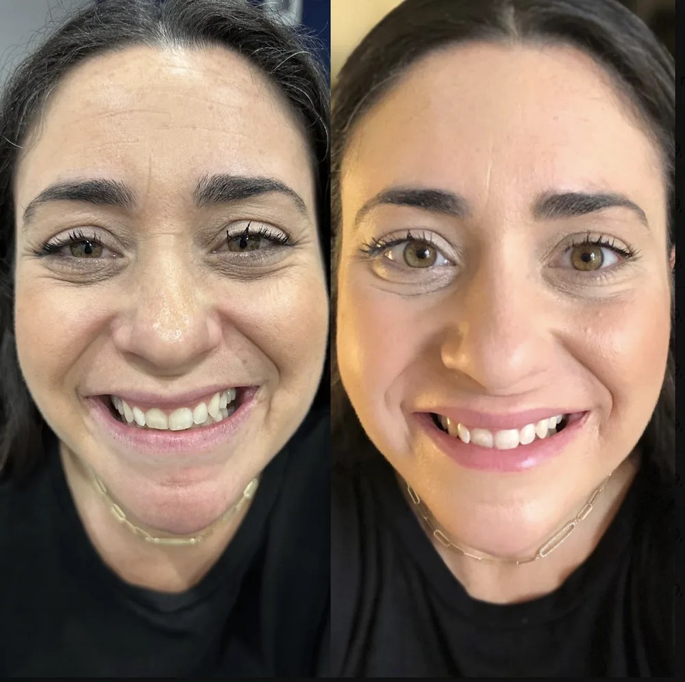 Full Face Botox before and after