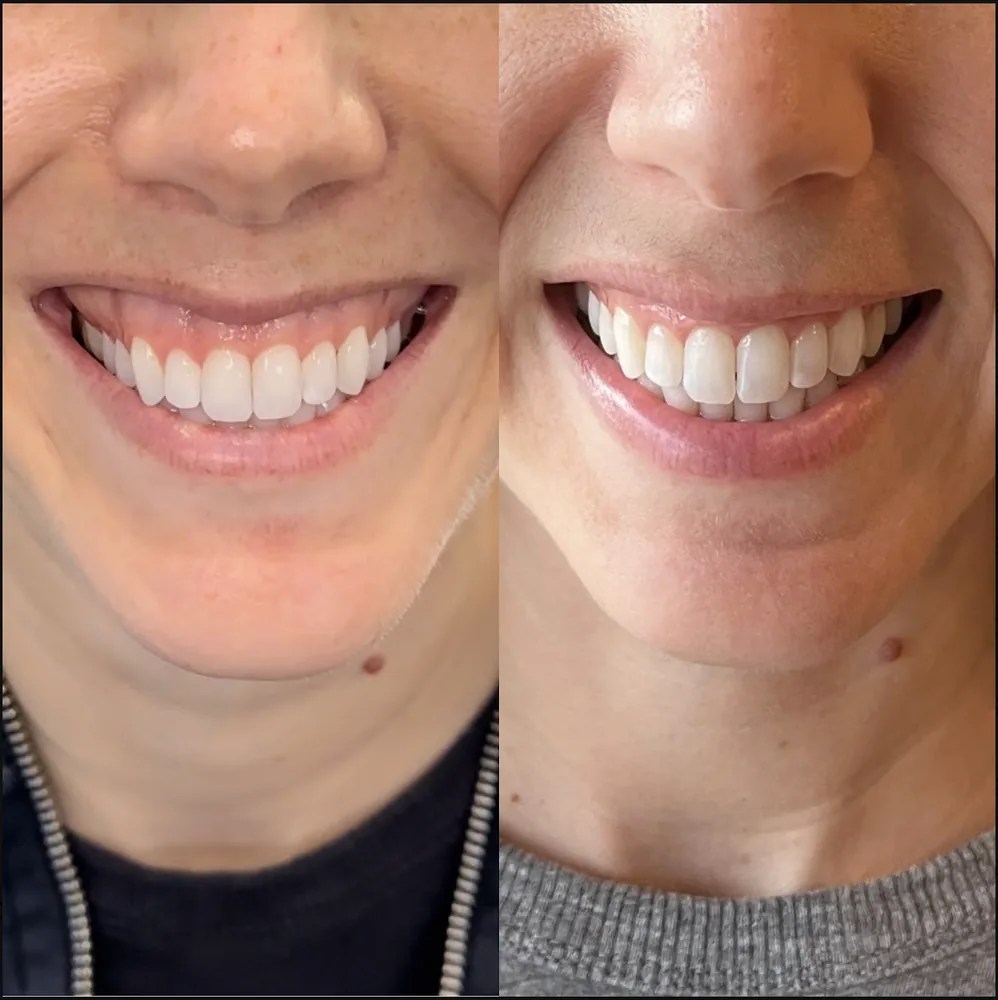 Gummy Smile before and after