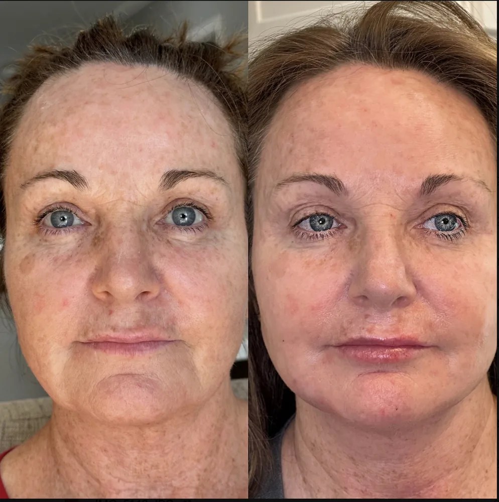 Full Face Filler before and after