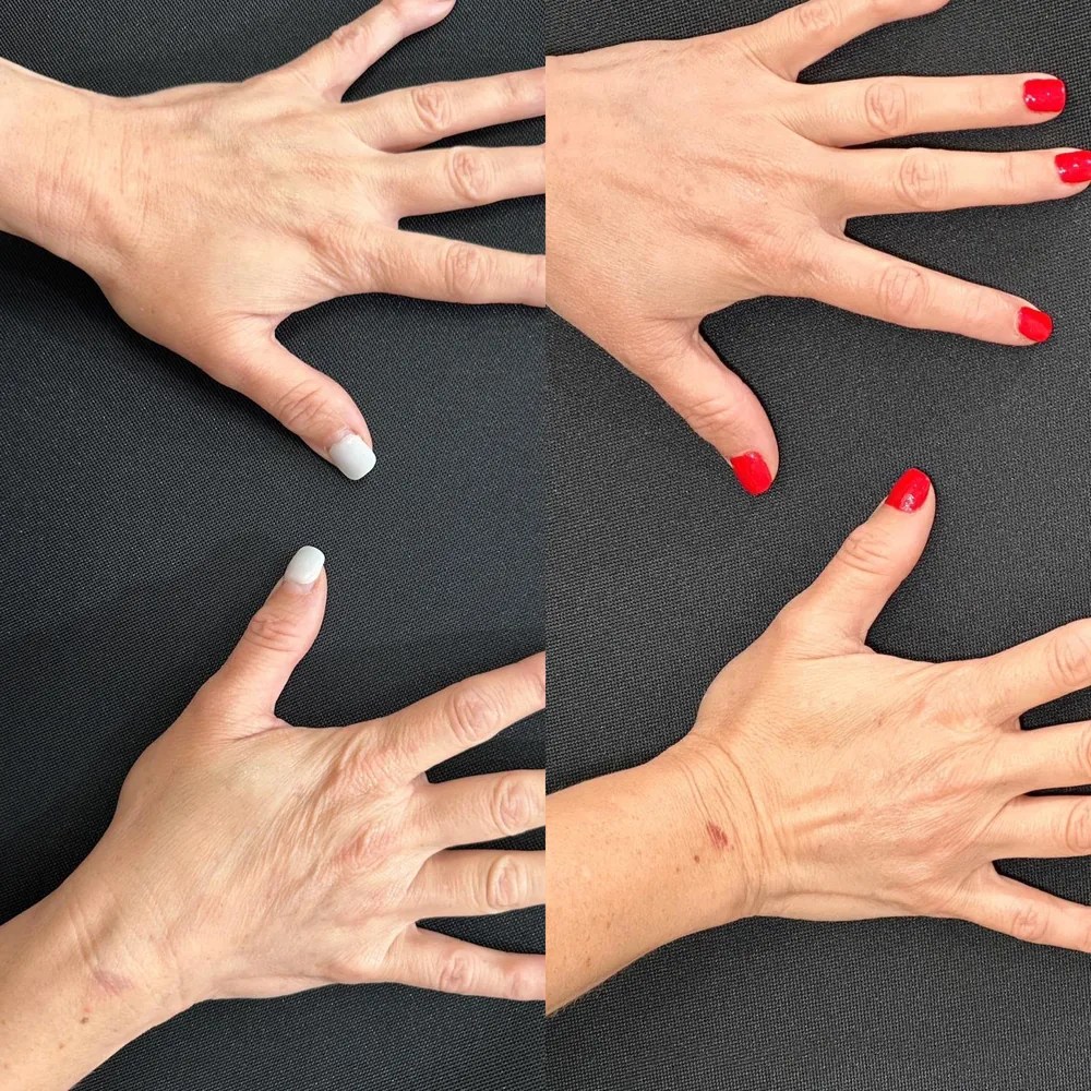 Hand rejuvenation