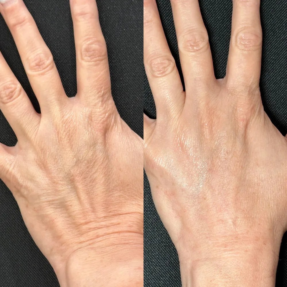 Hand rejuvenation