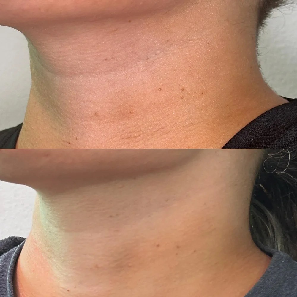Nefertiti neck lift