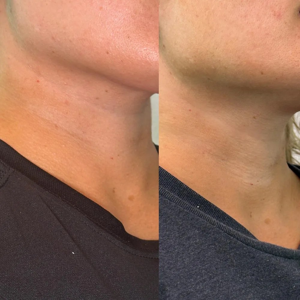 Nefertiti neck lift