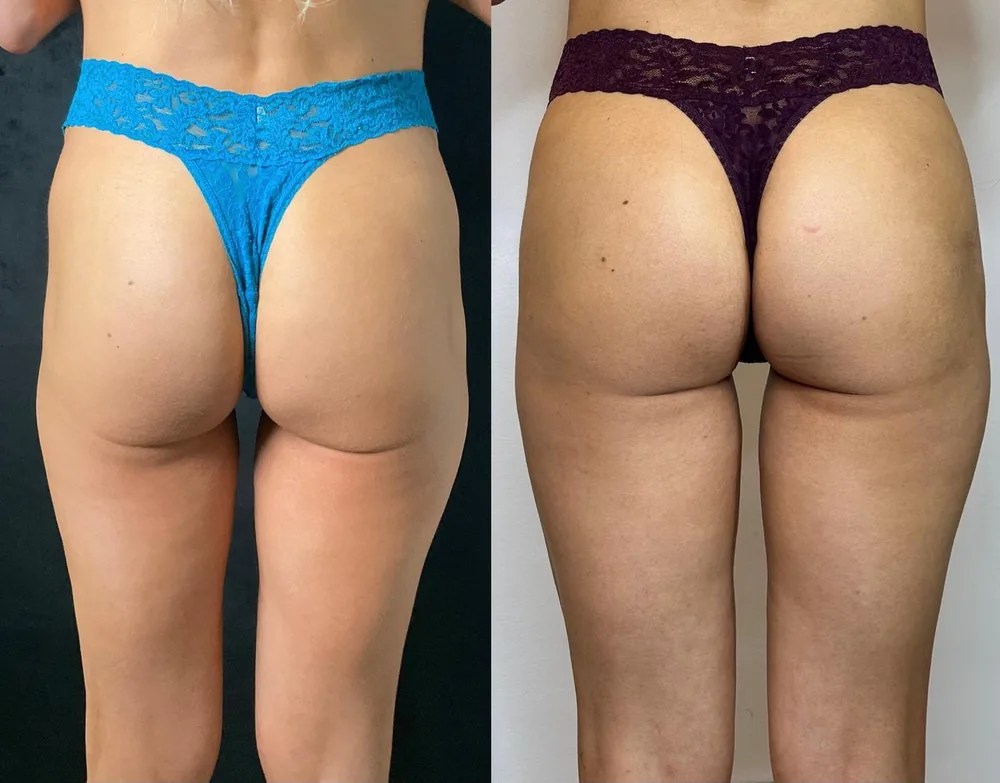 Radiesse contouring