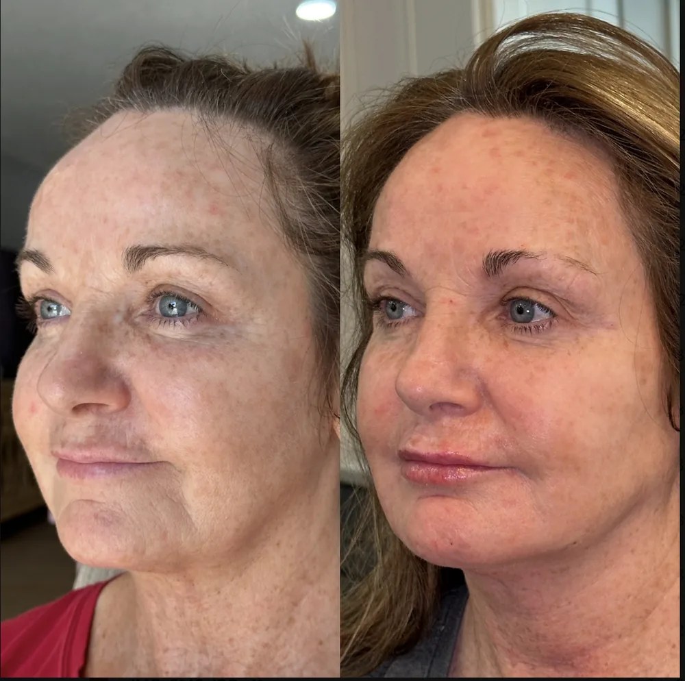 Full Face Filler before and after