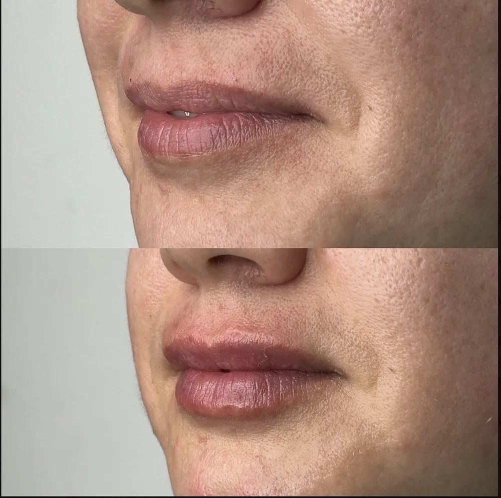 Lip Filler before and after