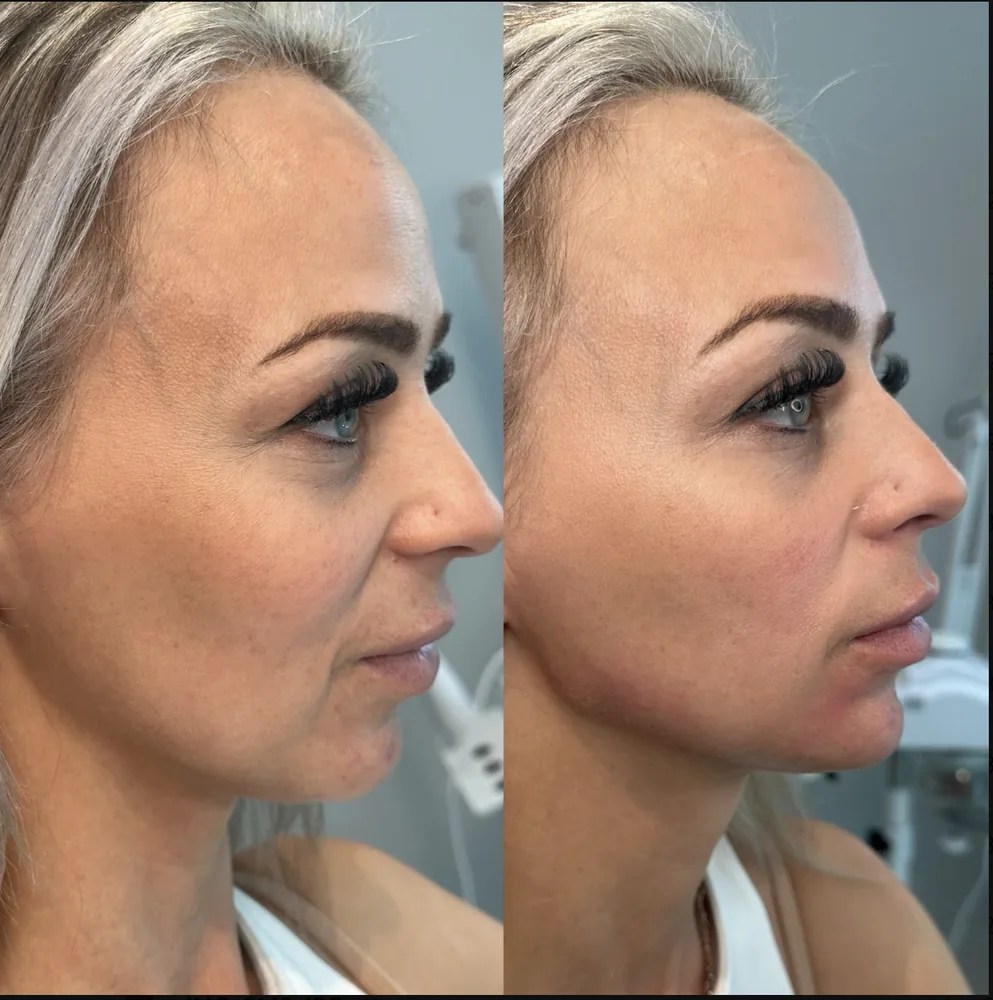 Cheek and Jawline Filler before and after