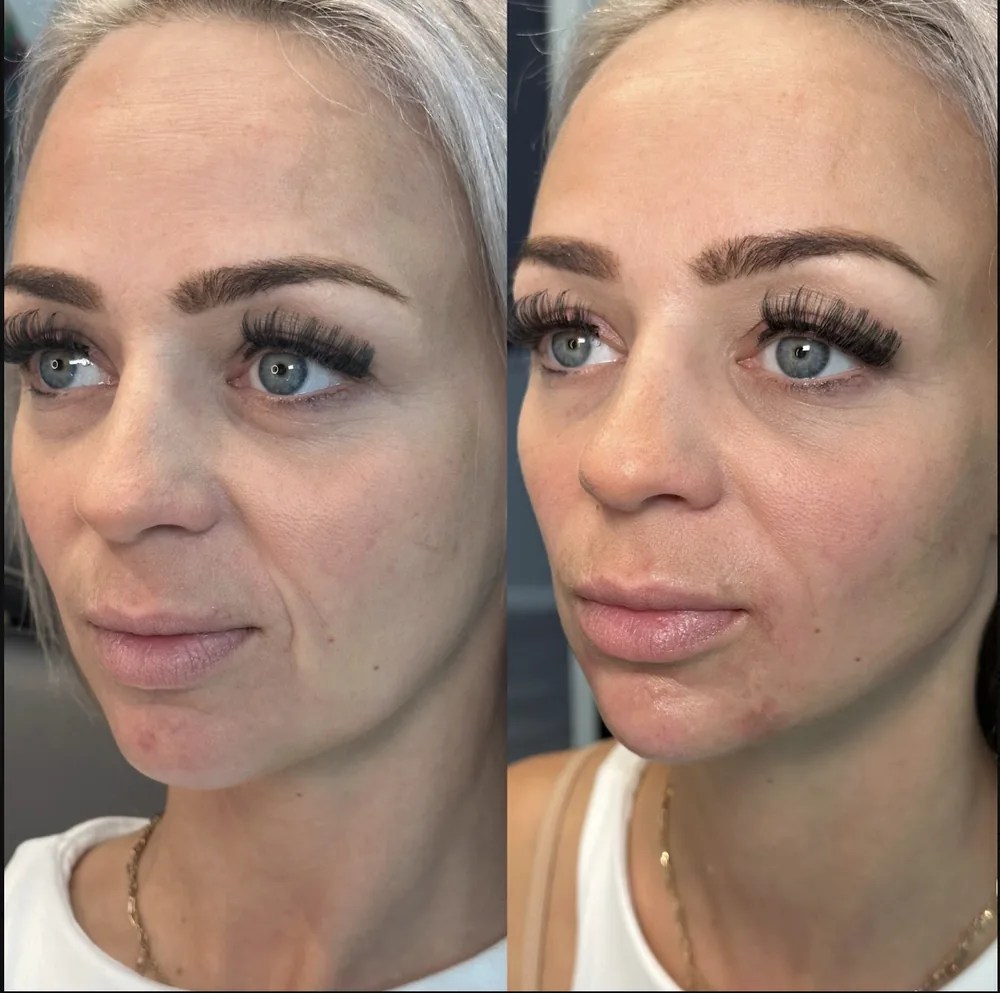 Cheek and Face Filler before and after