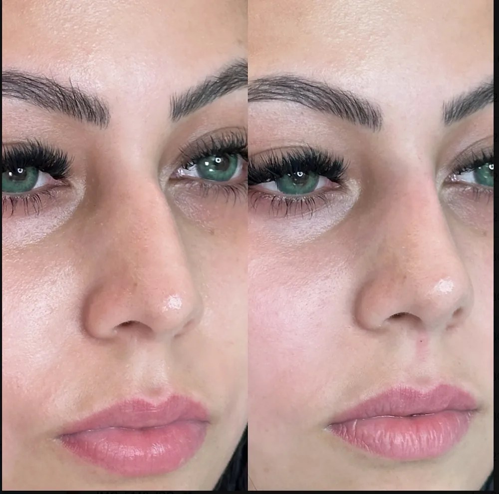 Nose and Lip Filler before and after