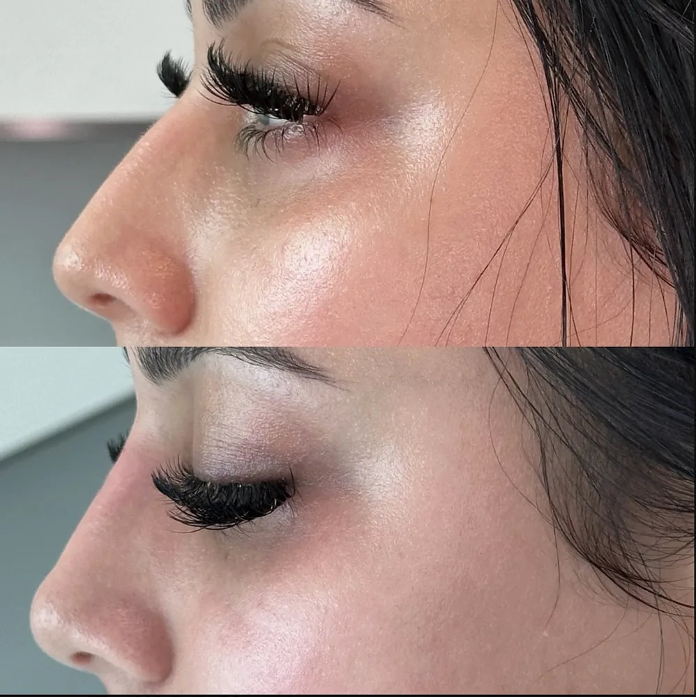 Nose Filler before and after