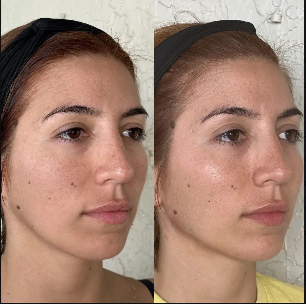 Full Face Filler before and after