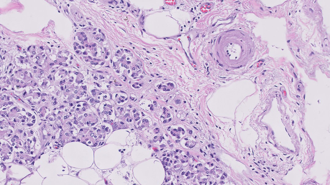 Diabetes Mellitus: Spleen histology with hyaline arteriolosclerosis 