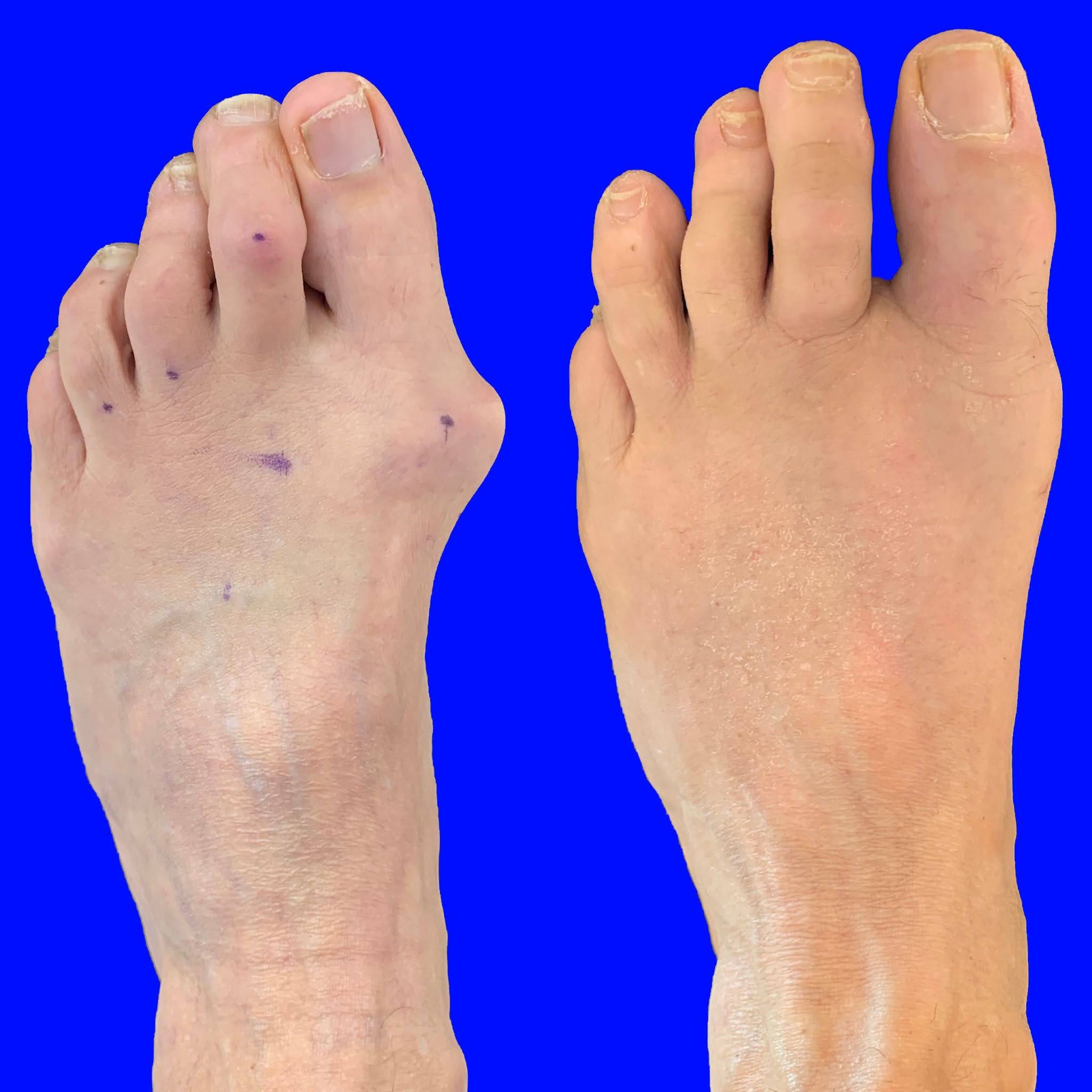 Before and After Bunion Surgery Photos Northwest Surgery Center