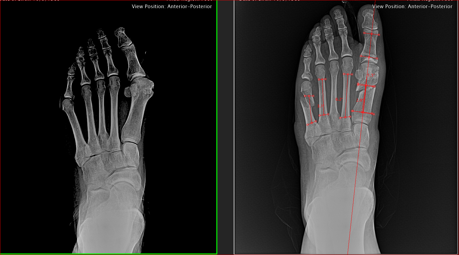 Bunion Surgery Options Northwest Surgery Center