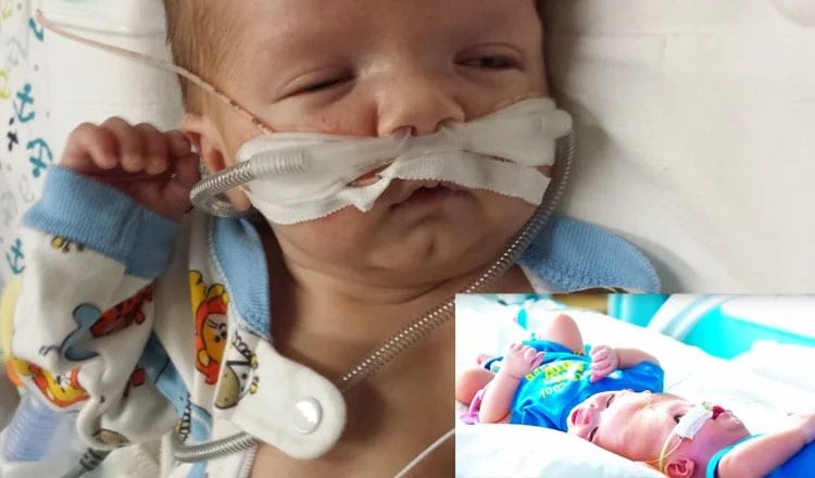 Conjoined twins open eyes after separation
