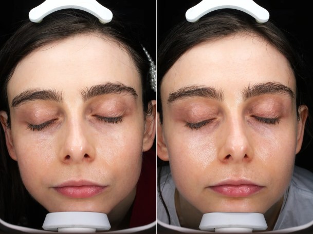 Before, and two weeks after Volite Treatment, fuller cheeks, healthier skin. 
