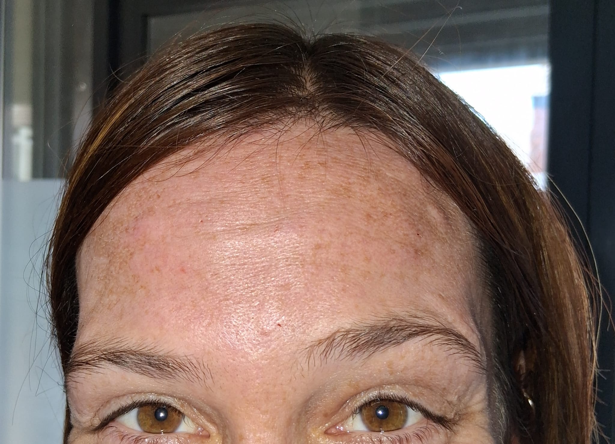 Anti-wrinkle treatment, after
