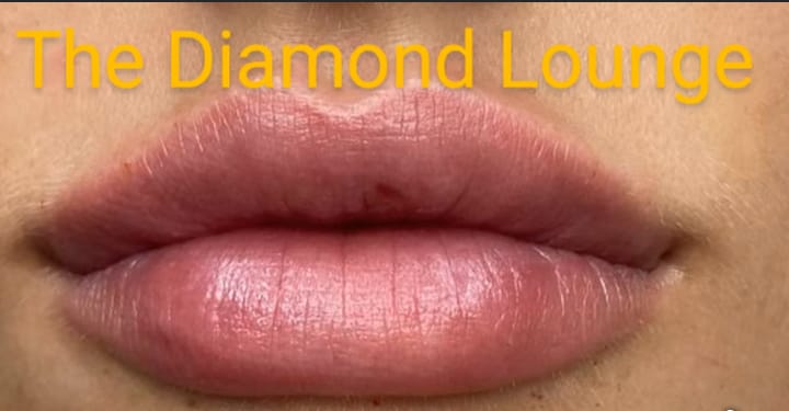 Lip filler treatment