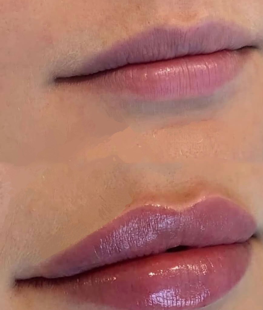 Lip filler treatment