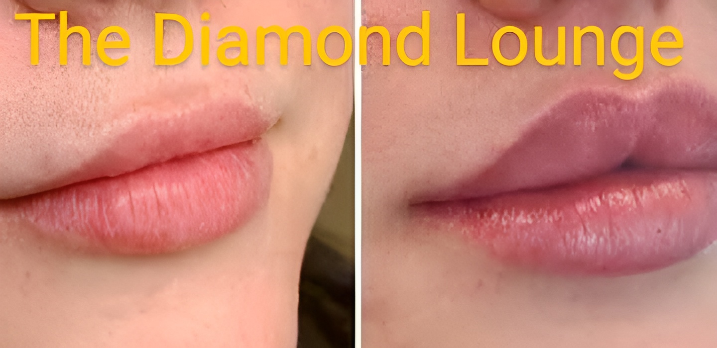 Lip filler treatment
