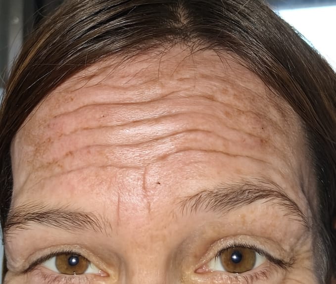 Anti-wrinkle treatment, before