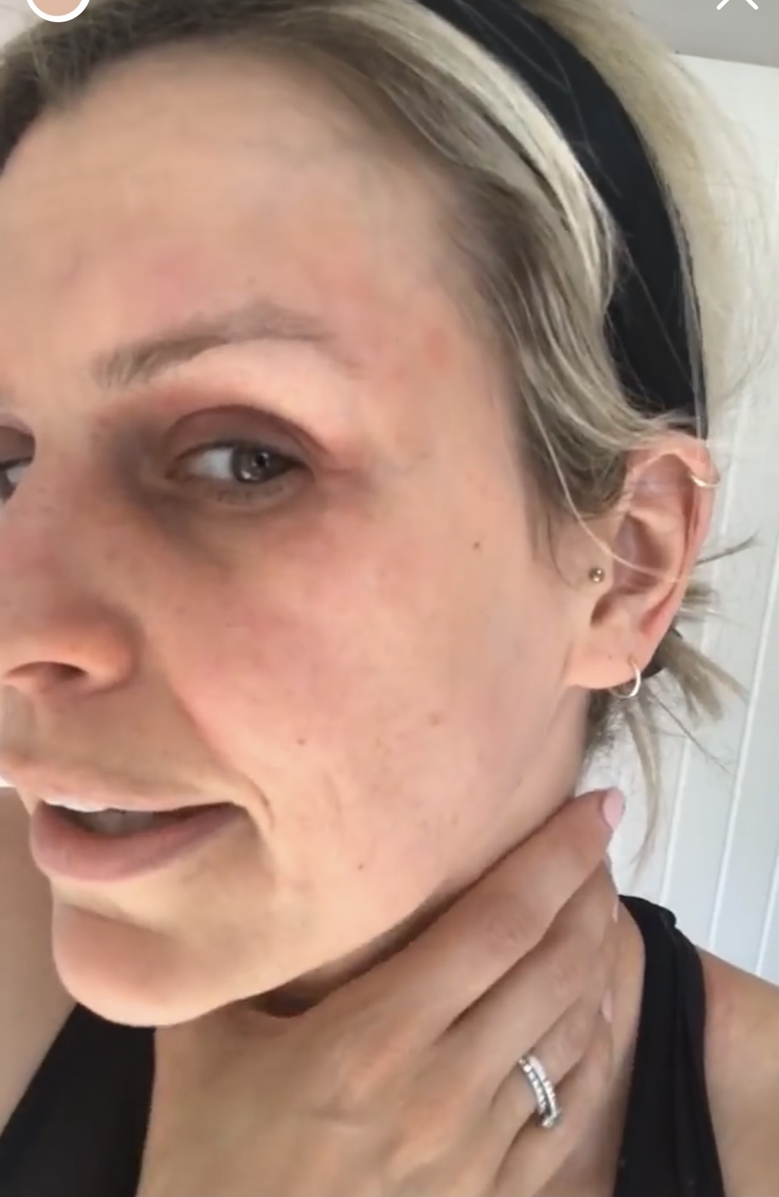 Image of face showing redness and irritation