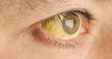 Yellow fever spreads in Malappuram vines; The number of infected people has reached 408