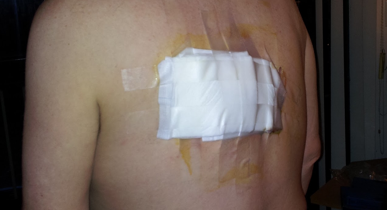My Wound