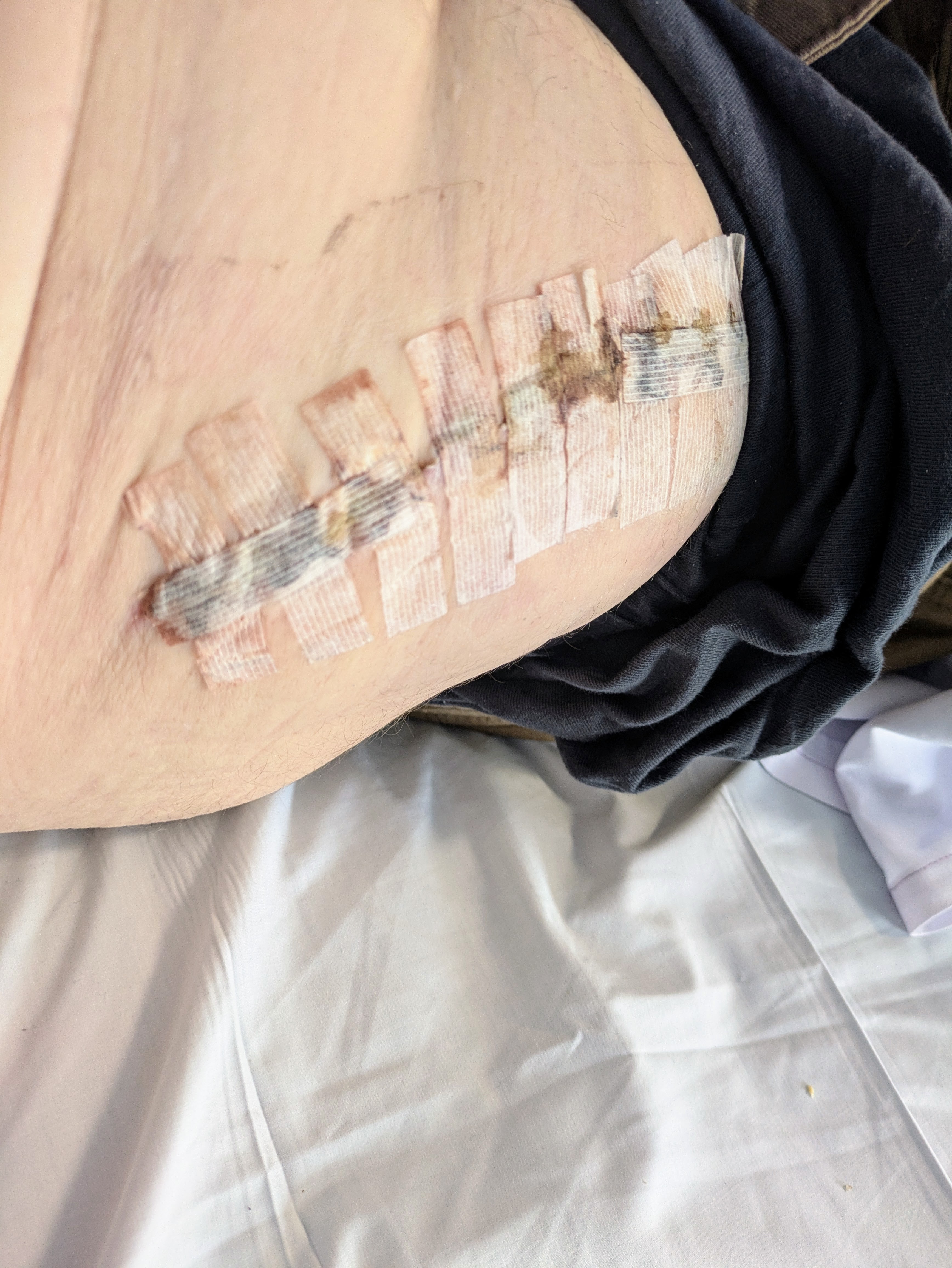 The hip replacement