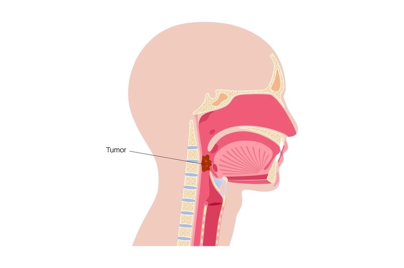 Carcinoma de laringe: sintomas e tratamentos