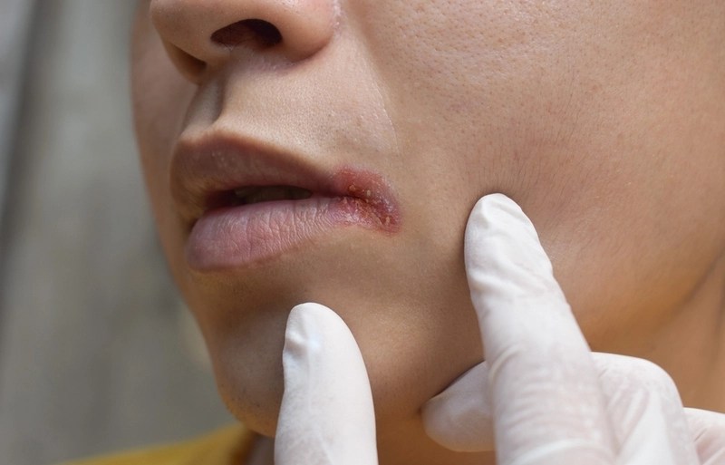 Câncer de lábio: prevenção, tratamentos e cirurgias