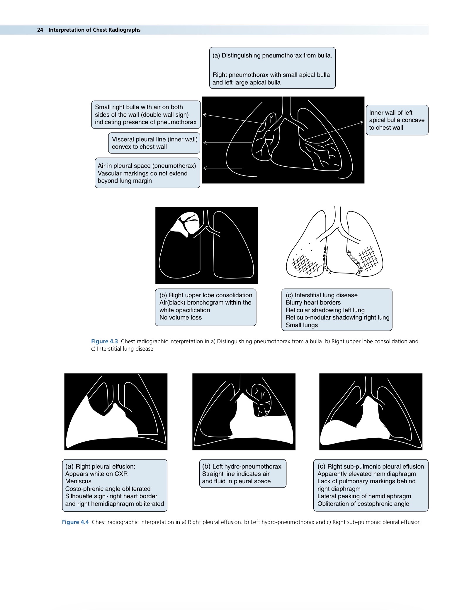 Respiratory - Chest Radiographs