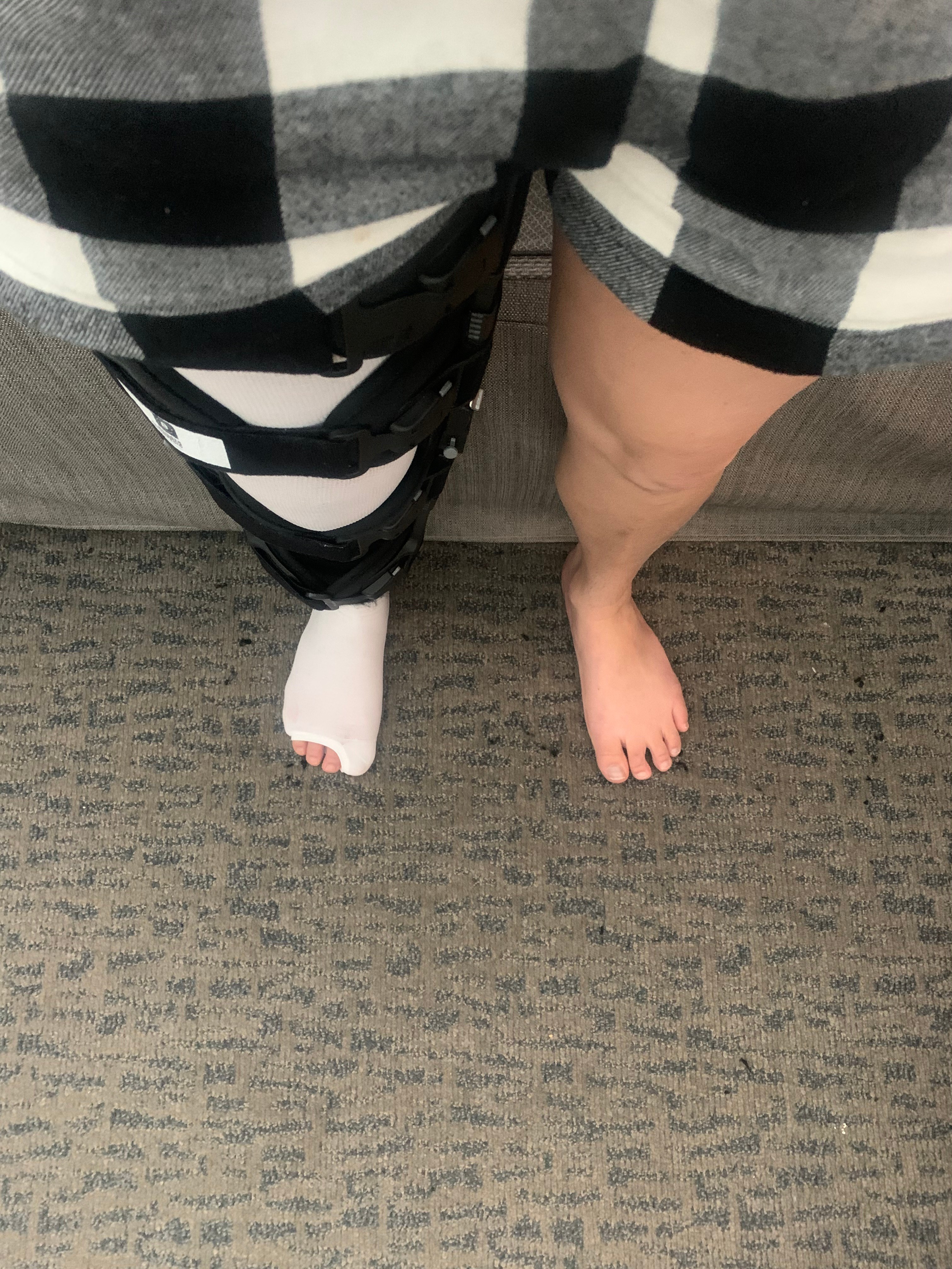 ACL Quad Tendon Reconstruction Personal Experience Blog