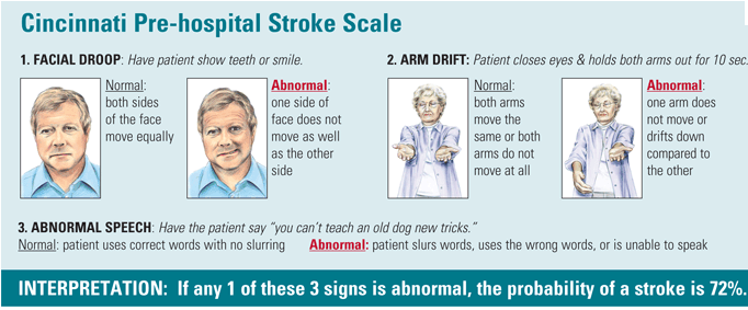 Cincinnati pre-hospital stroke scale