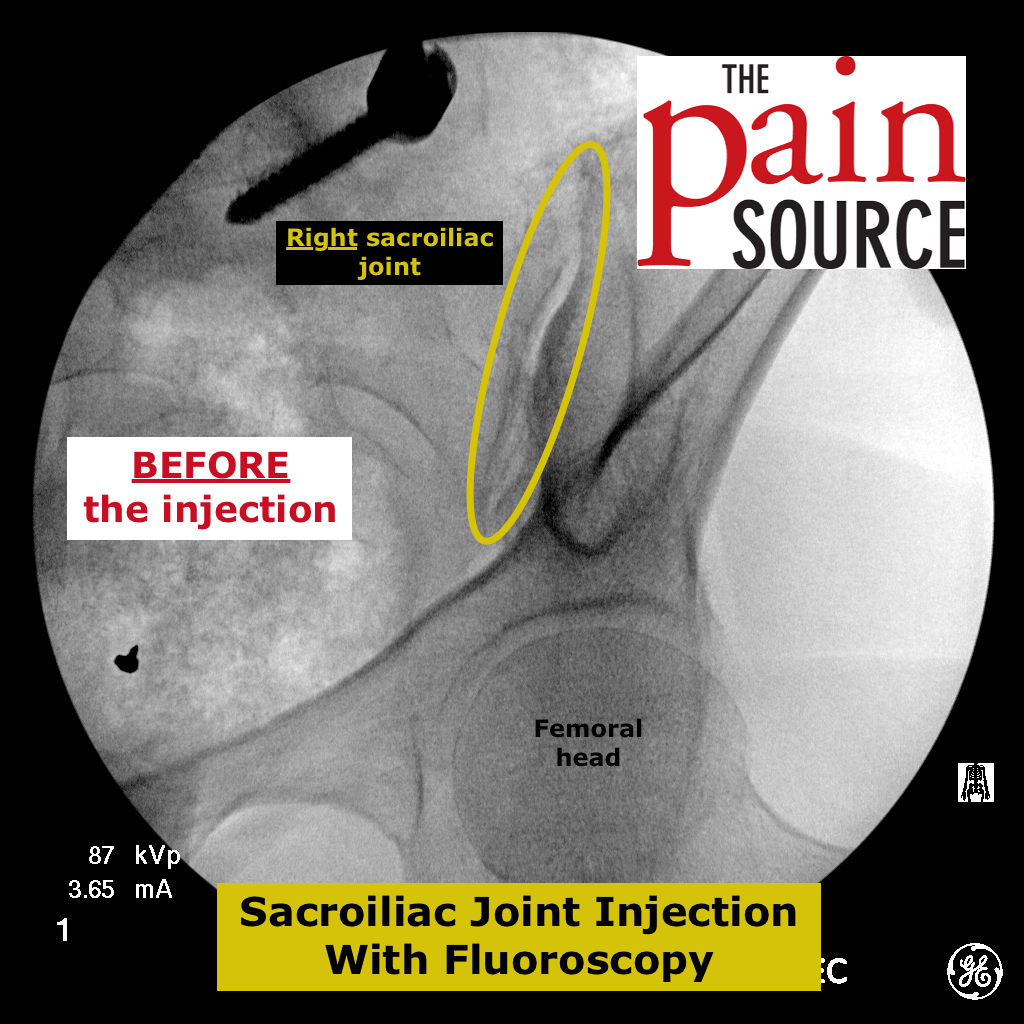 It may be used to check how the bladder and sphincter are working. Sacroiliac Joint Injection With Fluoroscopy - Technique