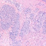 The (in)visibility of human tissue (journey of a dermatological mole)