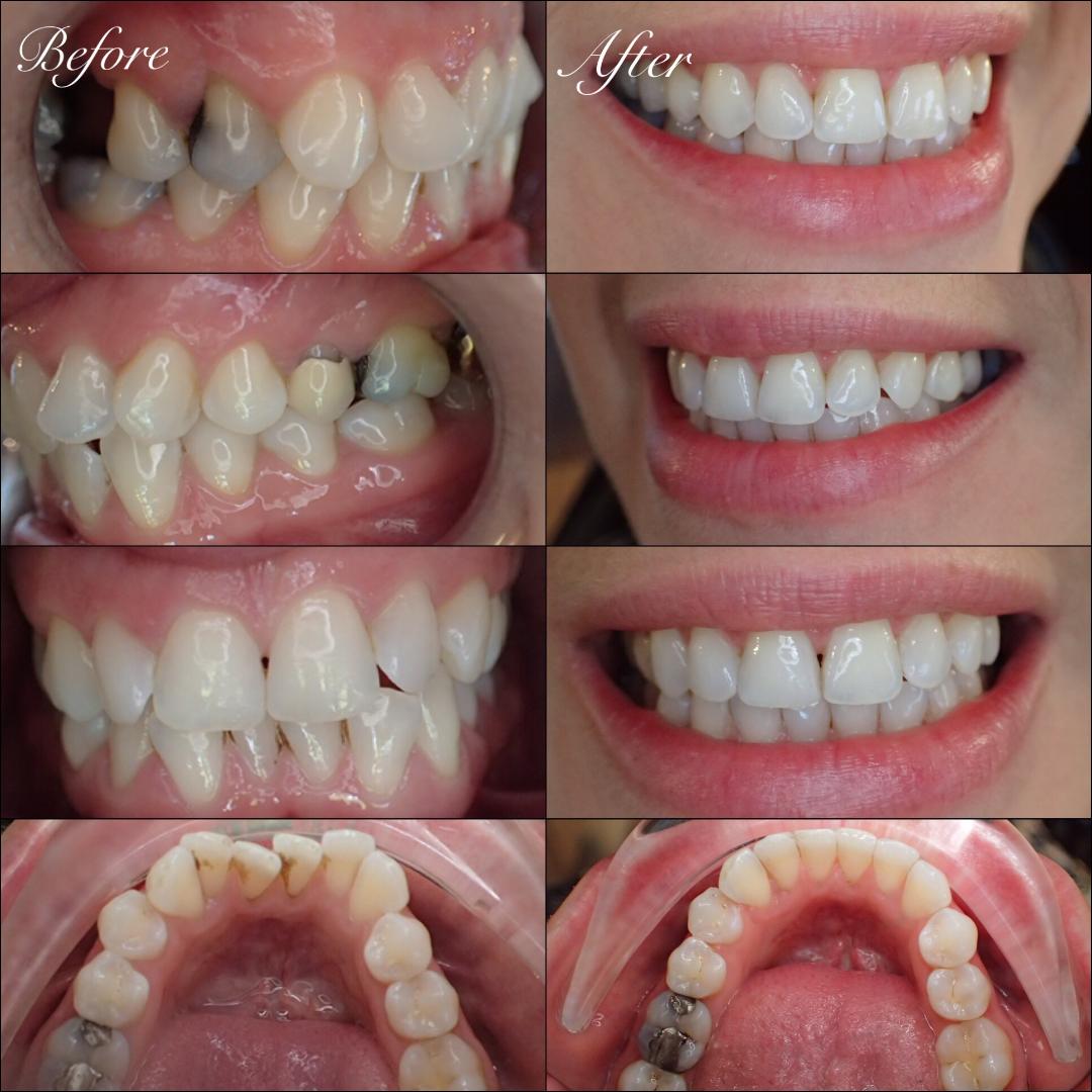 Women's health magazine shares the best lip glosses to whiten teeth, at womenshealthmag.com women's health may earn commission from the links on this page, but we only feature products we believe in. Dental Crown Exeter - The Whyte House Dental Practice