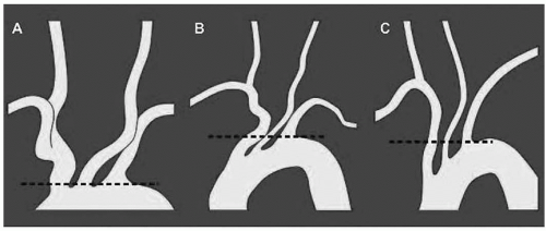 Great Vessel and Carotid Occlusive Disease | Thoracic Key