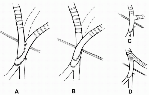 Alternative, Open Revascularization for Aortoiliac Occlusive Disease ...