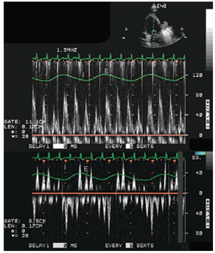 Evaluation of Left Ventricular Diastolic Function | Thoracic Key