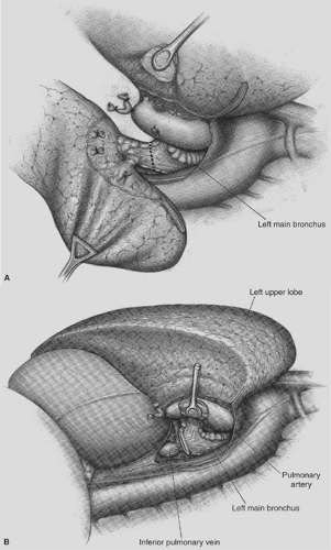 Technical Aspects of Lobectomy | Thoracic Key