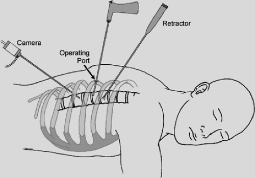 Anterior Transthoracic Approaches to the Spine | Thoracic Key