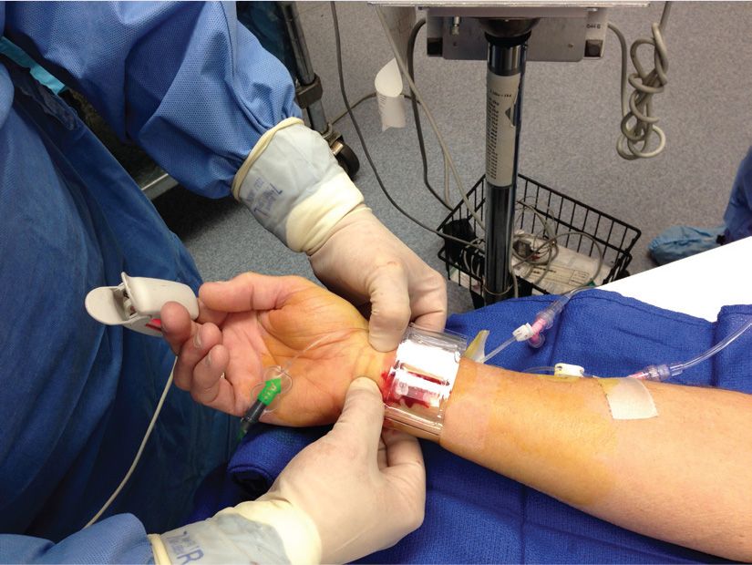 Hemostasis and Radial Artery Occlusion | Thoracic Key