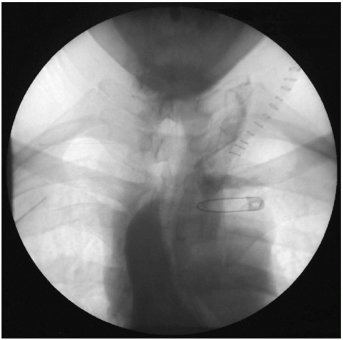 Esophageal Adenocarcinoma and Transhiatal Esophagectomy | Thoracic Key
