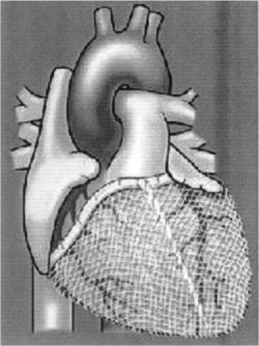Heart Failure Sedondary to Coronary Artery Disease | Thoracic Key