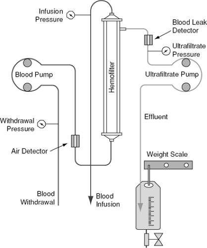 Ultrafiltration Therapies for Congestive Heart Failure | Thoracic Key