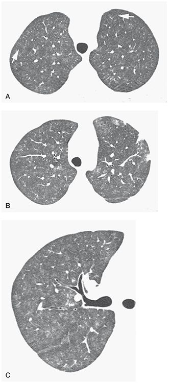 Pulmonary Hypertension and Pulmonary Vascular Disease | Thoracic Key