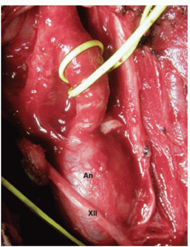 Operations on the Internal Carotid Artery | Thoracic Key
