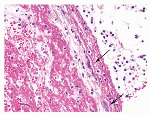 Histopathological evaluation of autopsy cases with isolated pulmonary fat embolism (ipfe): Pulmonary Embolism and Infarction | Thoracic Key