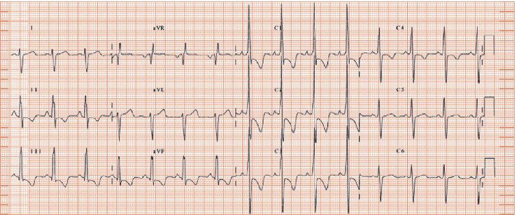 Pulmonary hypertension | Thoracic Key
